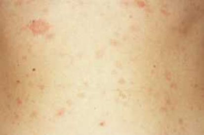 Pityriasis-Rosea4